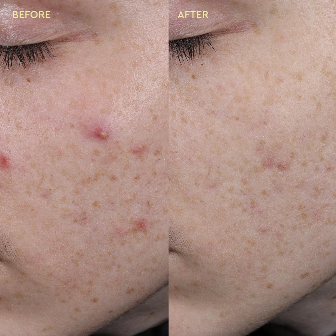BYOMA Blemish Clearing Paste - Reduces Redness, Unclogs Pores, Purifies Skin | 15ml 6